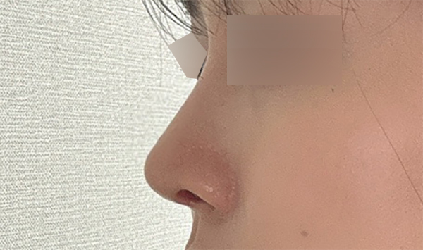From the Curve of the Nasal Bridge to the Tip: Refining the Line with Hump Nose Surgery image 5