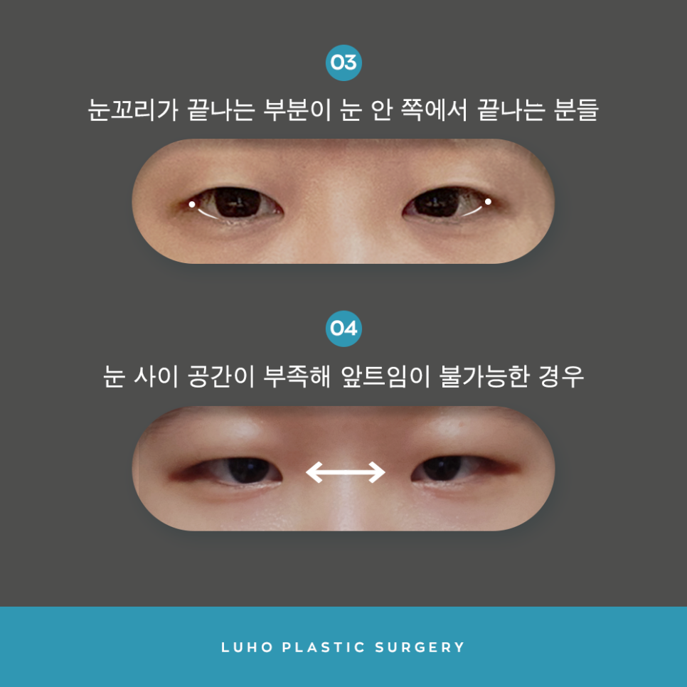 [루호성형외과] 작은 눈도 종류가 있다? 이런 분들은 꼭 트임 눈성형 하세요 관련 이미지 7