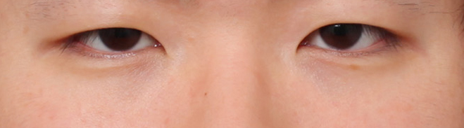 Before and After Male Eye Surgery at Sinsa Station That Created a Positive Impression image 3