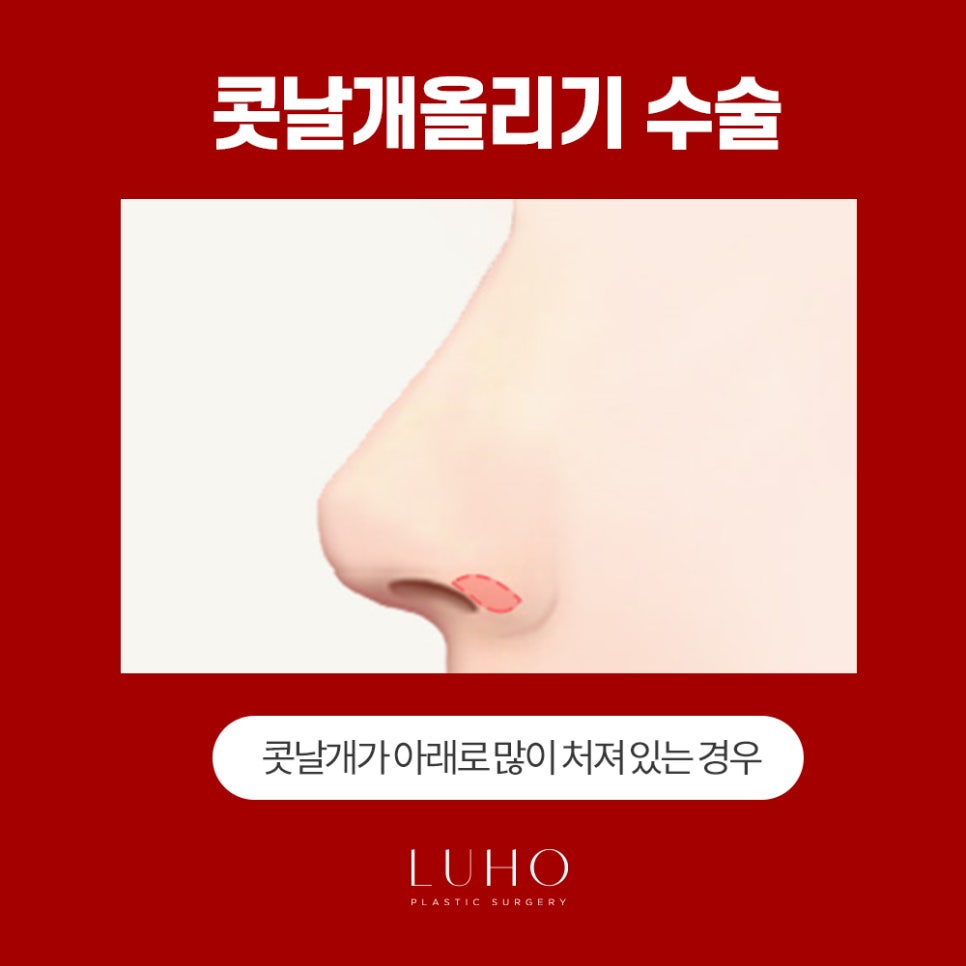 콧날개는 Down! 외모는 Up! 관련 이미지 10
