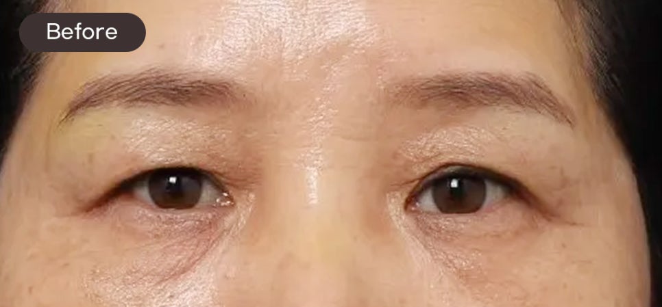 A Case of Correcting Midlife Eyelid Sagging with Upper Blepharoplasty at Sinsa Station image 3