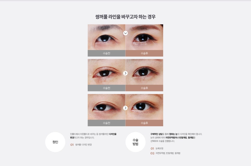 눈 수술법의 종류와 회복기간 #2 관련 이미지 15