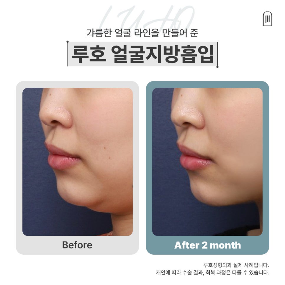 신사역얼굴지방흡입으로 슬림해진 모습 살펴보기 관련 이미지 1