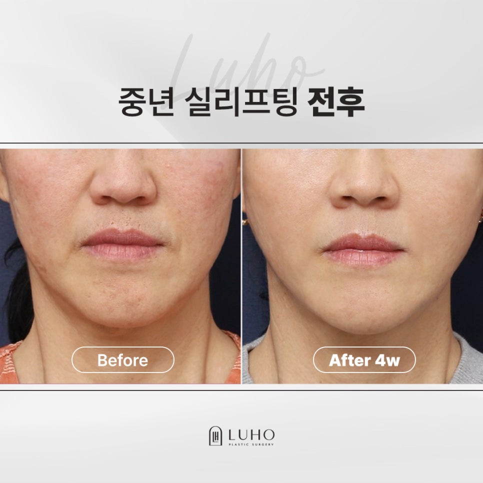 하안면 무게감을 줄인 신사역 중년 실리프팅 전후 관련 이미지 1