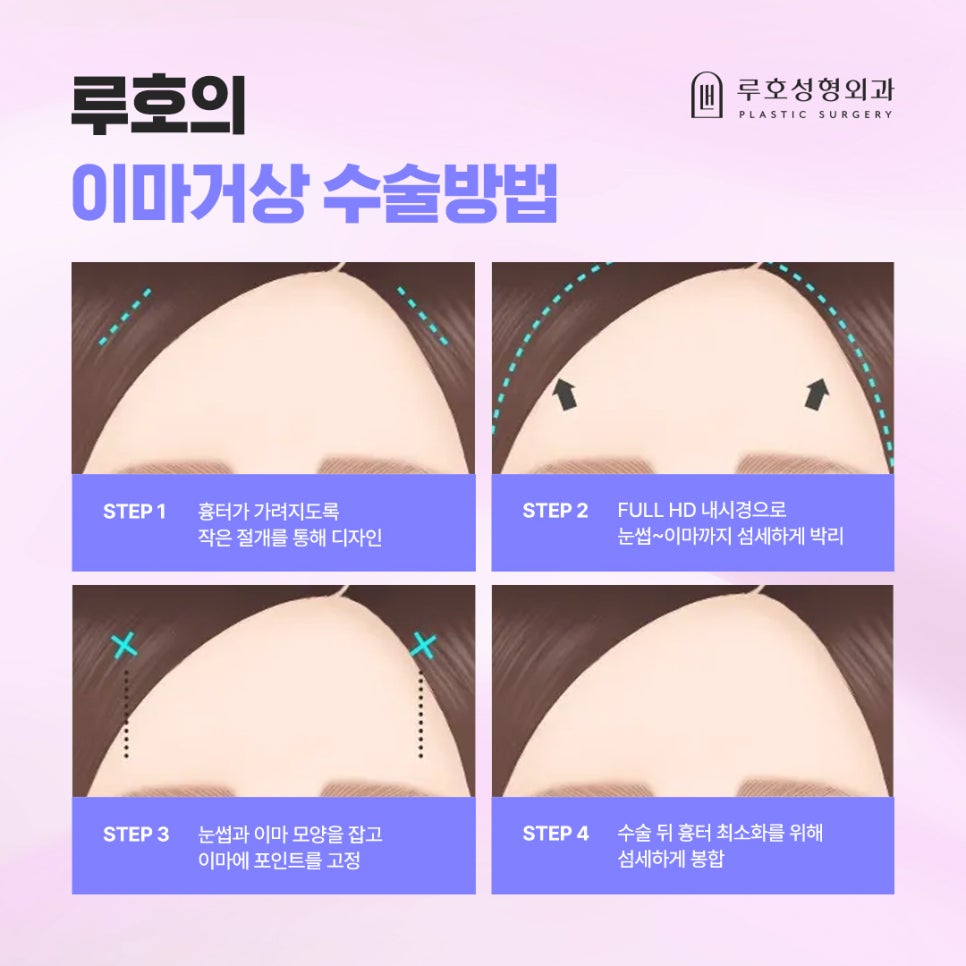처진 눈썹 바꿔놓은 신사역 이마거상 후기 관련 이미지 4