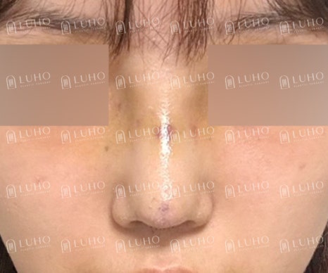 화려하고 또렷한 코 라인으로 개선한 수술 후기 관련 이미지 5