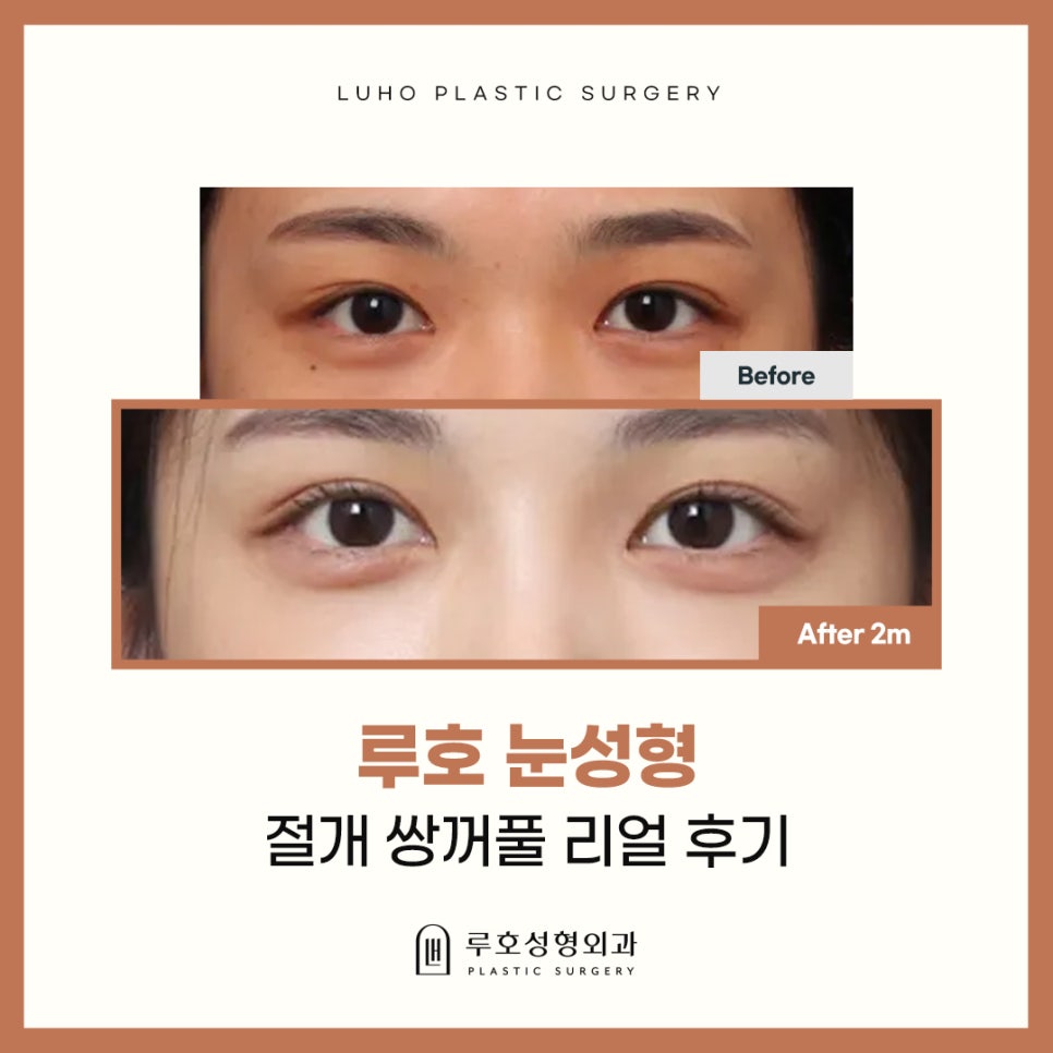 신사역 눈성형 : 절개 쌍꺼풀 수술 리얼 후기 관련 이미지 1