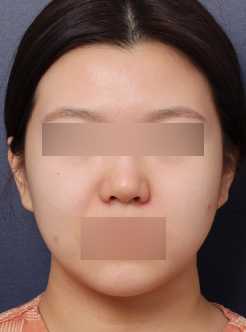 신사역 복코 재수술 전후 : 얄쌍한 콧대로 바뀐 사례 관련 이미지 2
