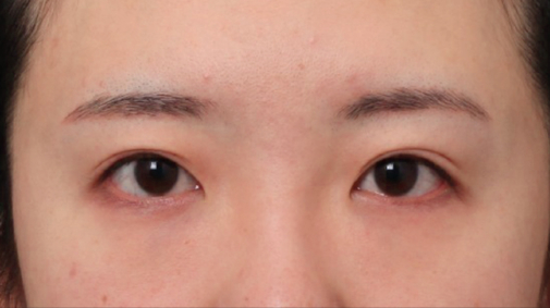 A Case of Forehead Lift Surgery That Gave a Heavy Appearance More Definition image 4