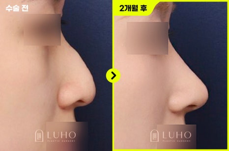 Non-Implant Rhinoplasty at Luho Plastic Surgery near Sinsa Station image 3