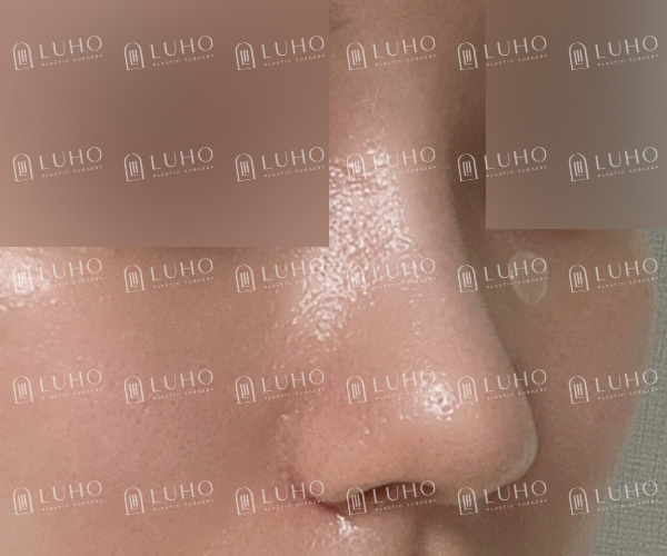 웃을 때 퍼져 보이는 코, 콧대부터 코끝까지 정리한 코수술 관련 이미지 5