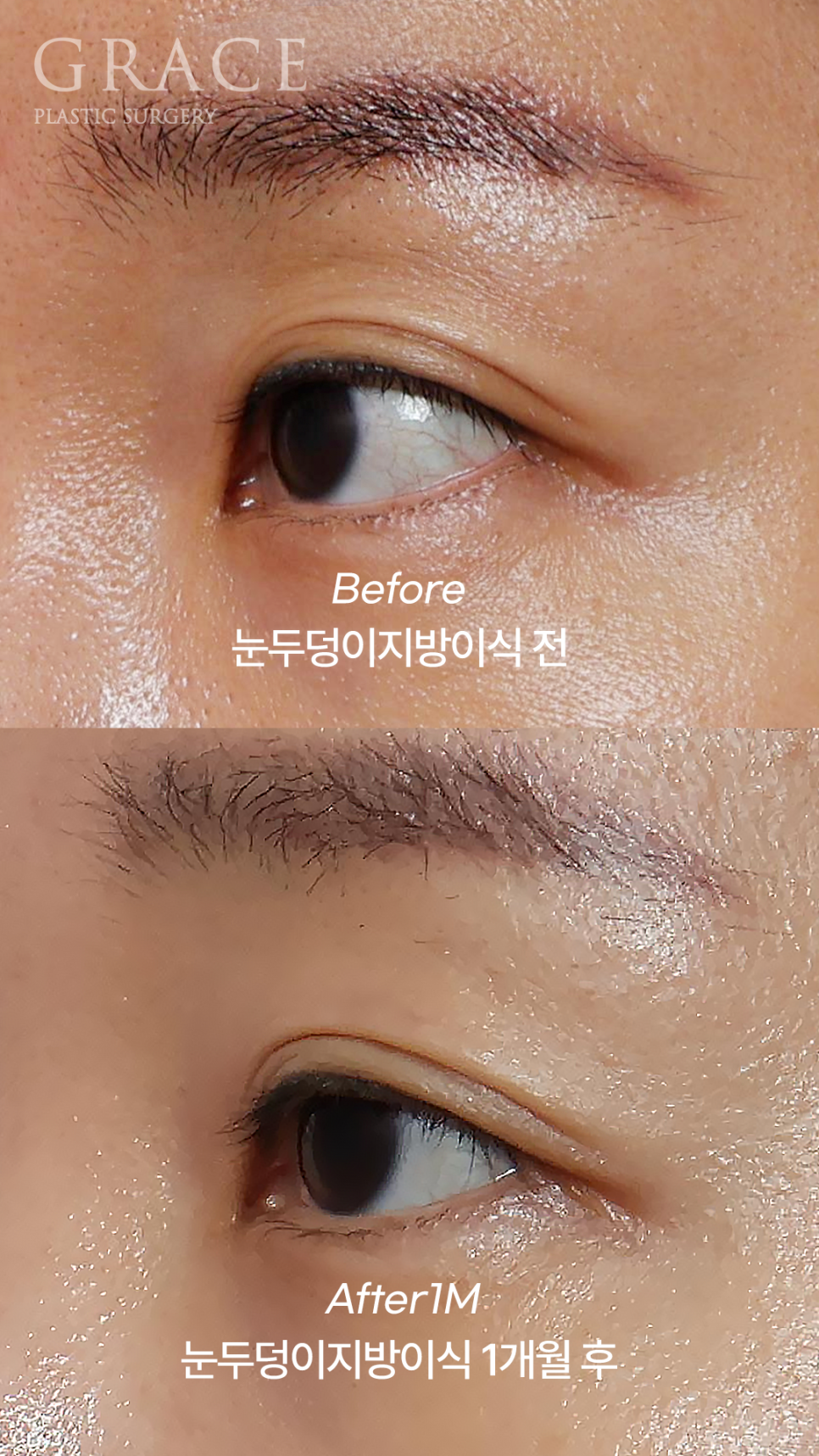 Why Eyelid Hollow Fat Grafting and Orbital Fat Injection Are Important: From Duration of Results to How to Prevent Bumpy Side Effects image 12