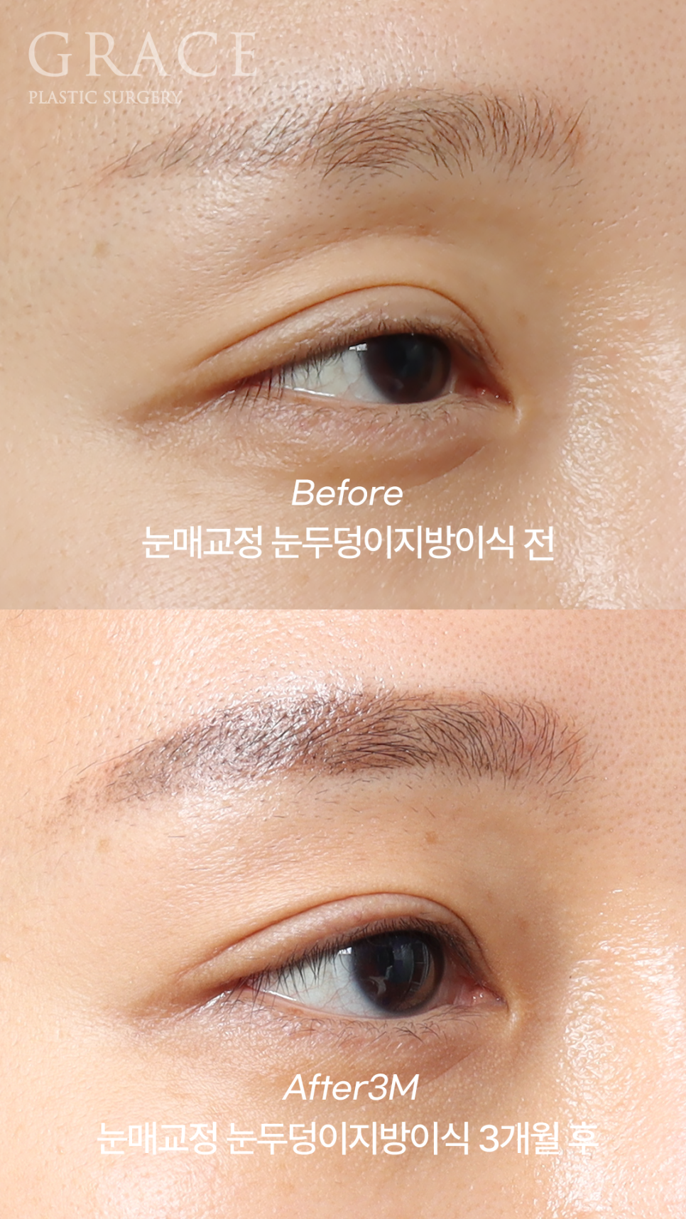 실패한 돌출눈성형 (눈매교정과 눈두덩이 지방이식) 관련 이미지 3