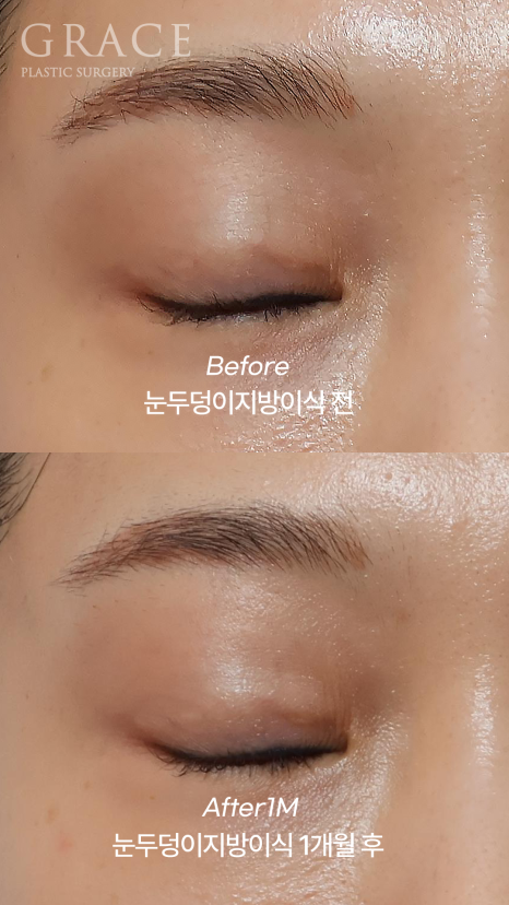 눈두덩이 꺼짐 개선을 위한 지방이식 관련 이미지 5