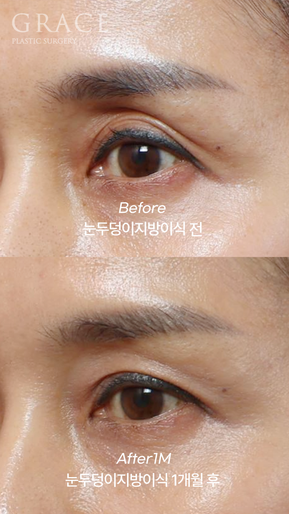 How to Fix a Sunken Eye Hollow: Upper Eyelid Fat Grafting + Ptosis Correction image 4
