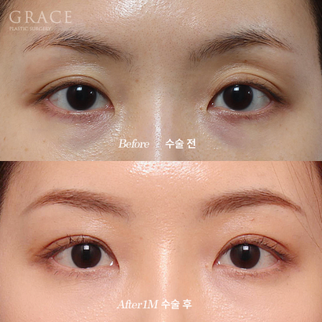 그레이스성형외과 Before&middot;After 아이홀 지방이식 잘하는 곳 관련 이미지 3