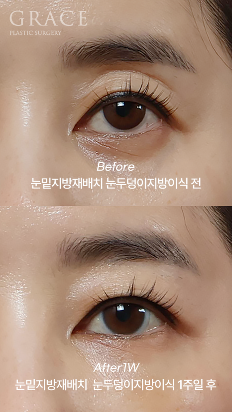 Under-Eye Fat Repositioning & Eyelid Fat Grafting: Double the Swelling? Before and After 1 Week image 5