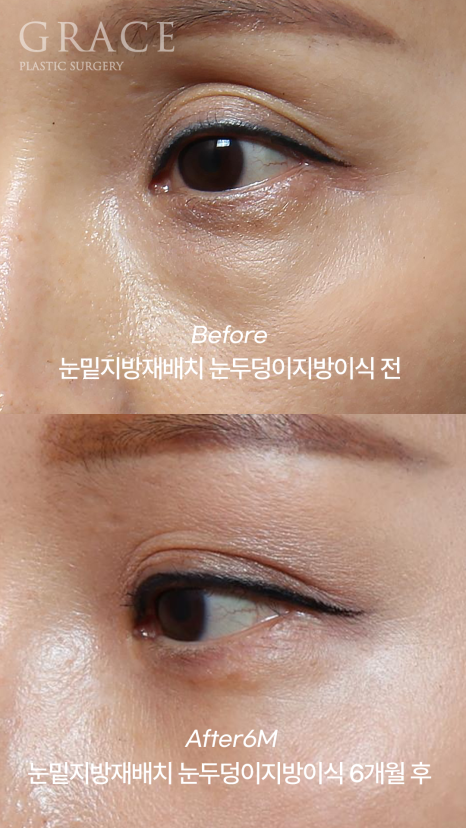 Eye Surgery for People in Their 50s That Reduces Time, Cost, and Recovery: Upper Eyelid Fat Grafting & Under-Eye Fat Repositioning image 4