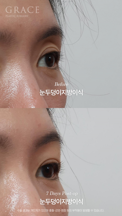 눈두덩이 지방이식 같은 내 지방인데 왜 울퉁불퉁해질까? 지방의 크기부터 다르니깐 관련 이미지 4