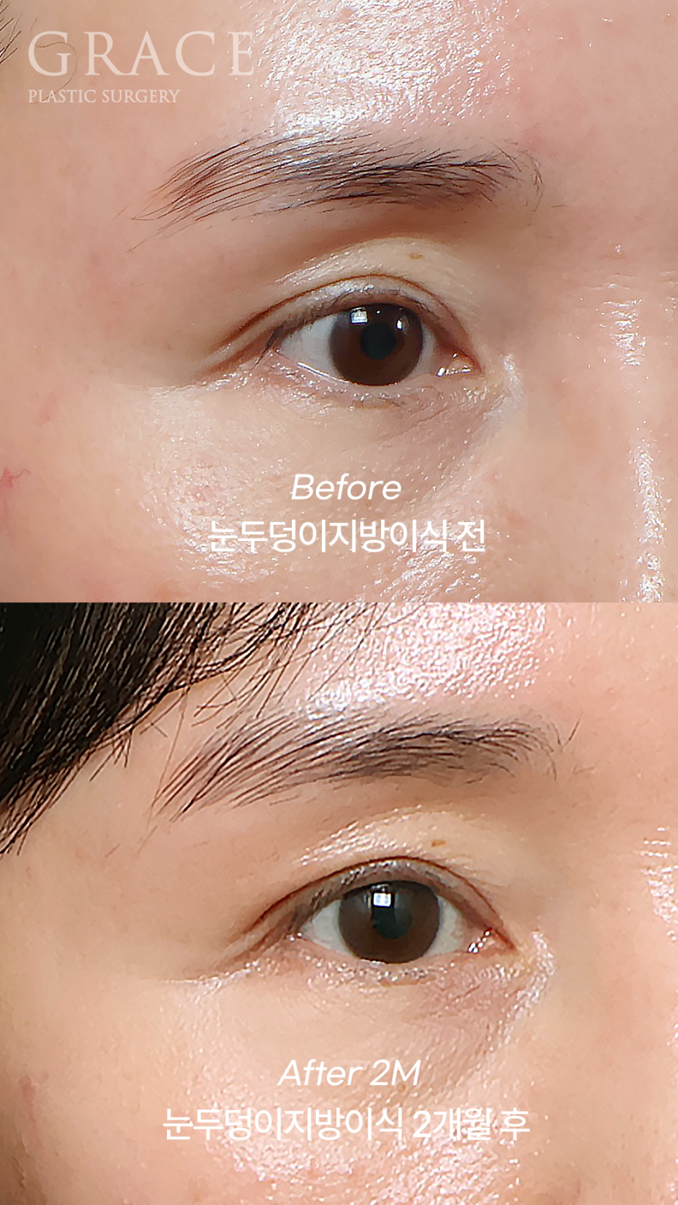 눈꺼풀 지방이식 부작용 왜 생기는지 아시나요? 관련 이미지 7