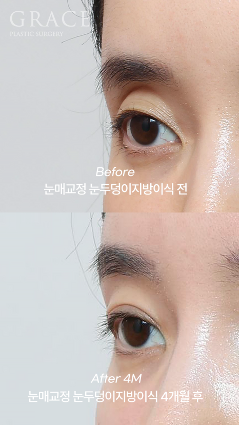 Review of 1cc Eyelid Fat Grafting for Sunken Upper Eyelids (Mid-30s, 4 Months Post-op Swelling and Scarring) image 7