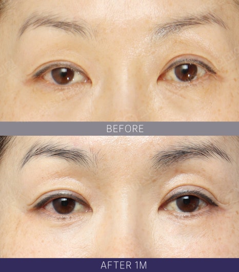 Hollow Eye Holes + Under-Eye Puffiness → (Upper Eyelid Fat Grafting + Fat Repositioning) image 9
