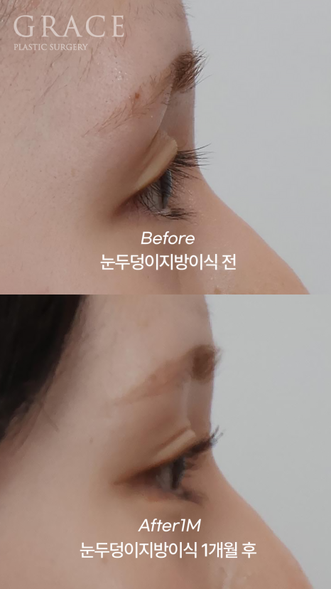 In Your Mid-20s, If You Have Ptosis Before and After Upper Eyelid Fat Grafting, Is Eye Correction Essential? image 9
