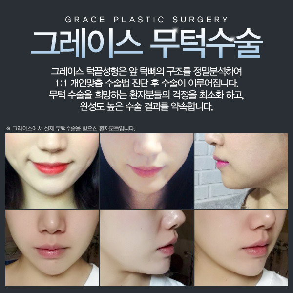 신사역 그레이스성형외과에서 무턱수술로 라인 완성! 관련 이미지 4
