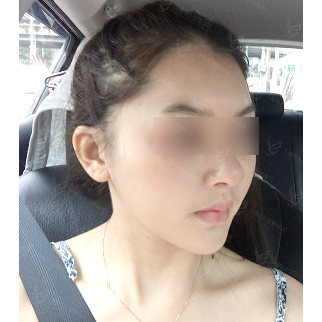 Quick Cheekbone Reduction Surgery Review for a Smooth Facial Line! image 1