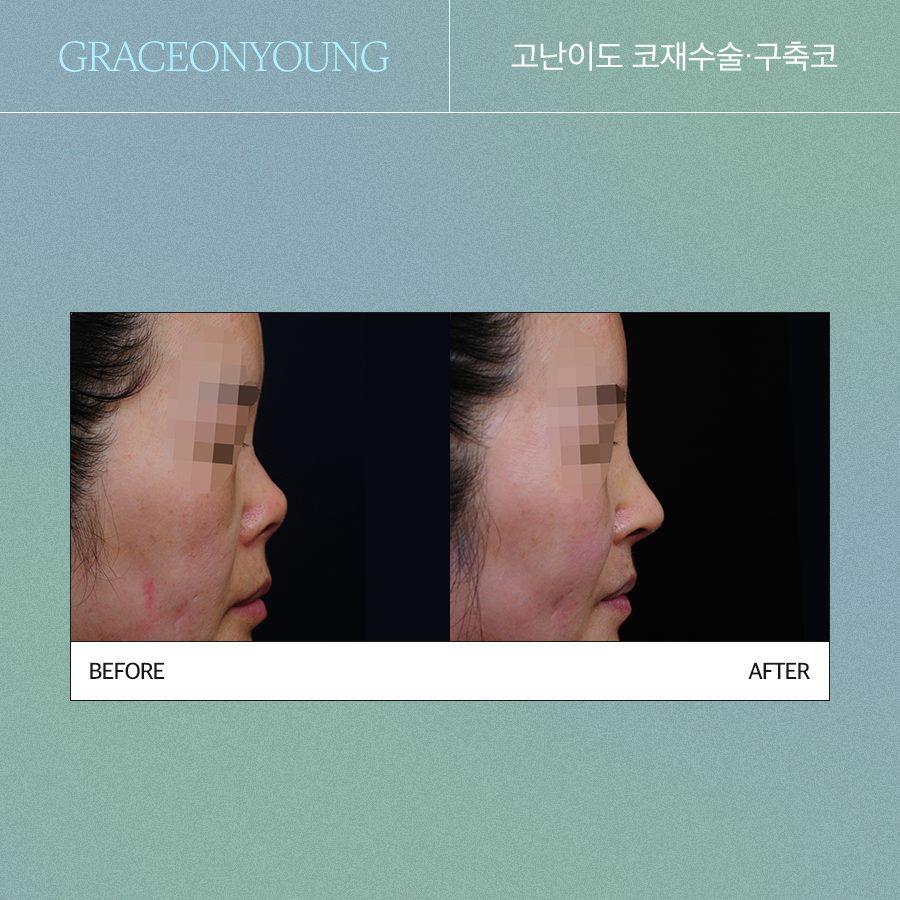 비단코 성형, 이규호 원장님 코끝 성형 관련 이미지 2