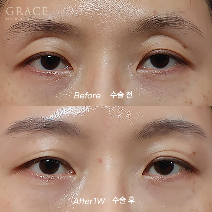 The Basis for a 94.5% Functional Improvement: Fat Grafting Technology That Fills in a Sunken Eye Hollow image 1