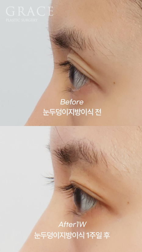 Recovery Timeline Before and After Eyelid Orbital Fat Grafting: 1 Week image 8