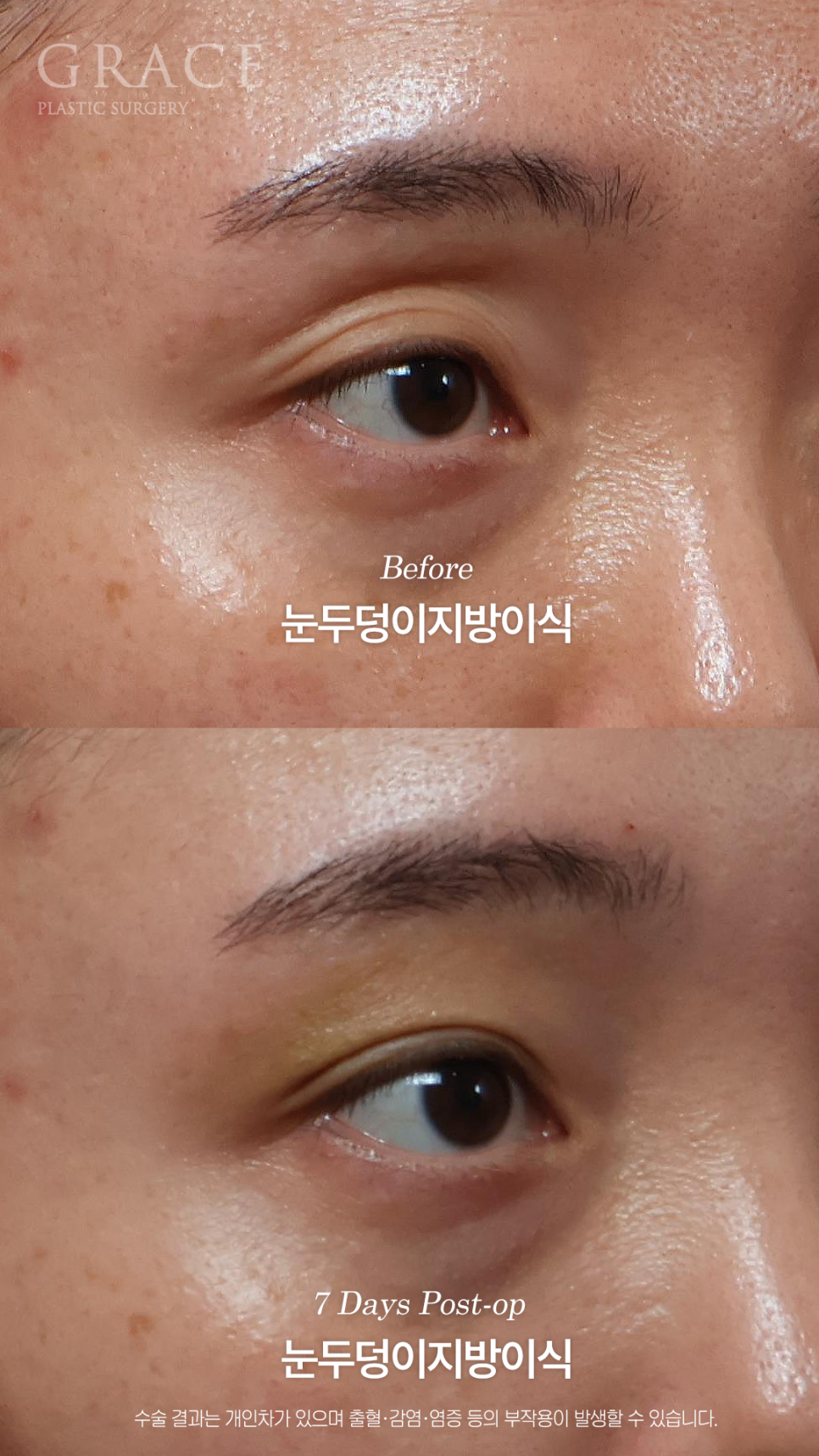 그레이스성형외과 눈두덩이 지방이식으로 채웠는데 눈이 더 잘 떠지는 이유 관련 이미지 7