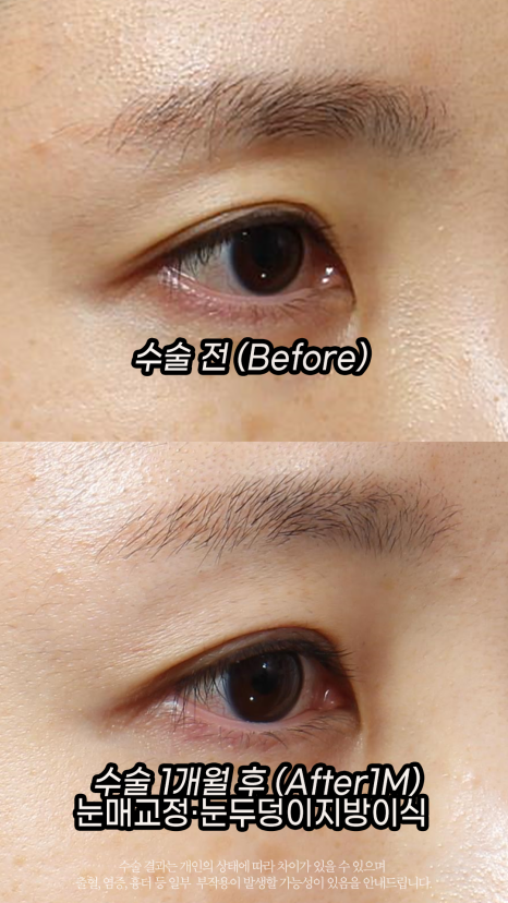If Sunken Eyelids Are Left Untreated, About Hollows in the Eye-Hole Area (Fat Grafting) image 5