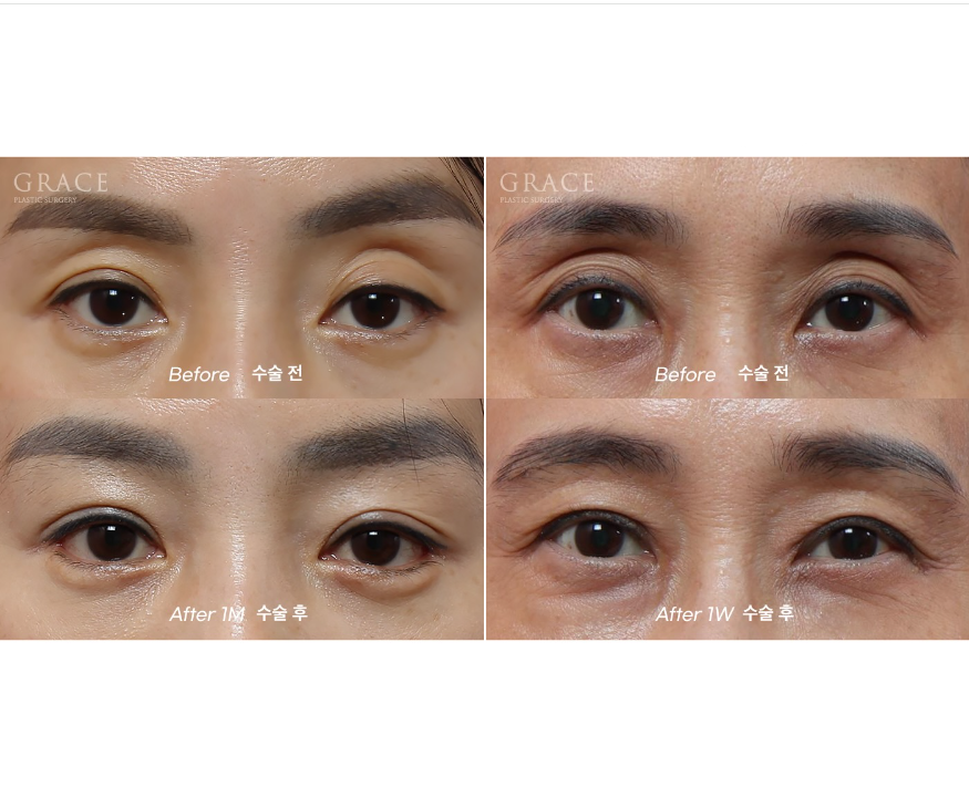 What Matters More Than Swelling After Eye Hollow Fat Grafting: Injection Location and Survival image 4