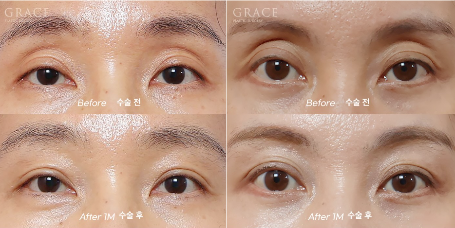 Why Do Hollow Eyelids Occur, and How Can They Be Naturally Improved? (Research Notes from a Doctor Performing Eyelid Fat Grafting) image 14