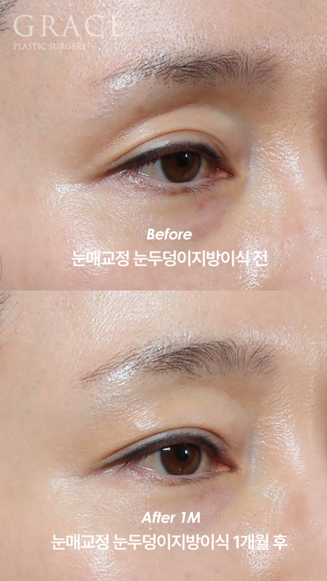 What Is the Problem with the Side Effects of a Lumpy Eyelid Fat Graft? image 4