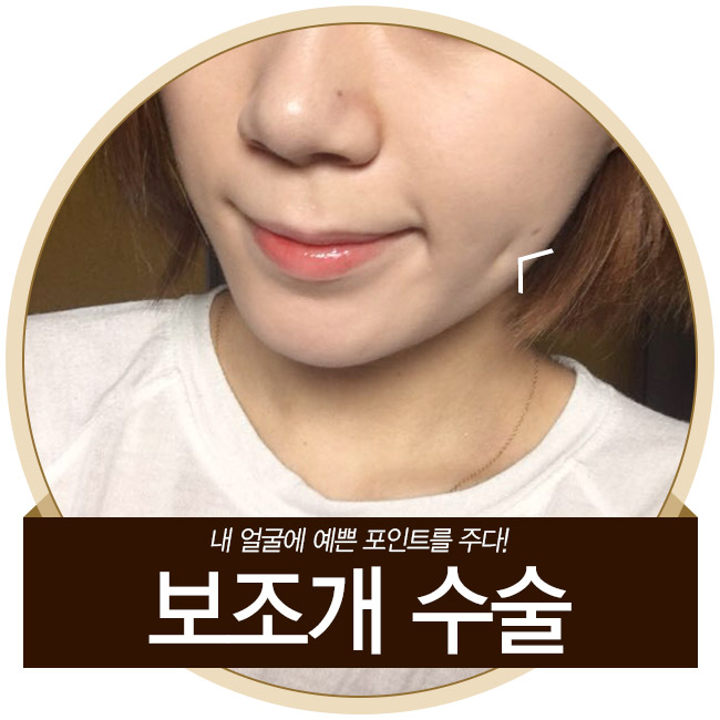 보조개수술 잘하는 곳! 그레이스성형외과 관련 이미지 4