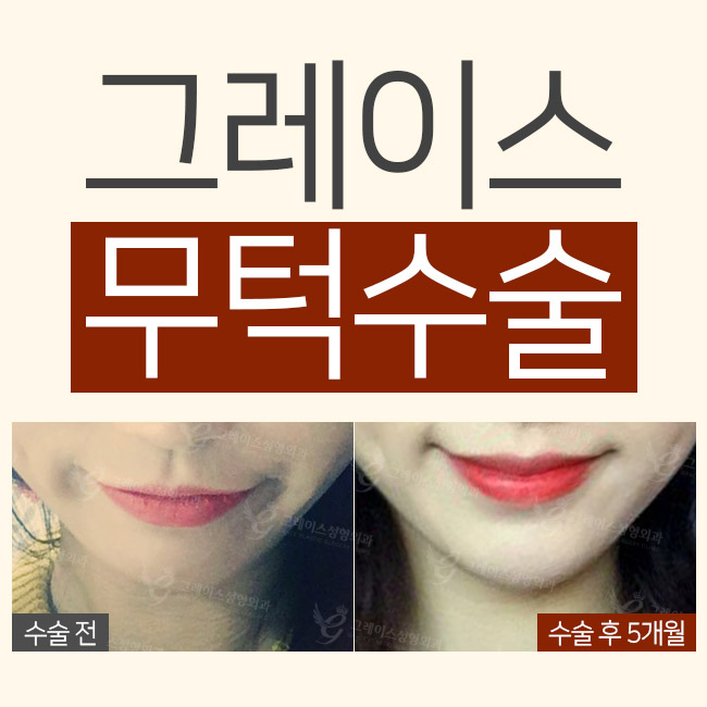 세련된 얼굴라인을 원한다면 무턱수술이 정답! 관련 이미지 3
