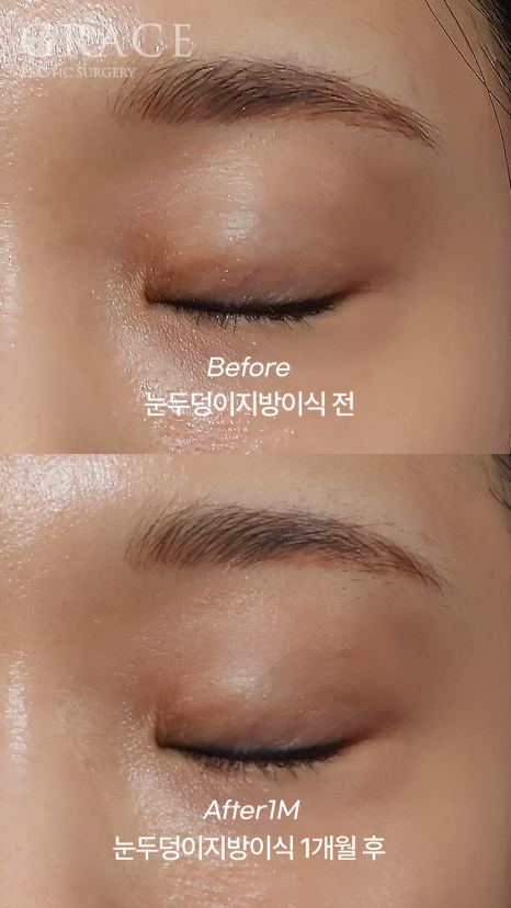 눈두덩이 꺼짐 개선을 위한 지방이식 관련 이미지 2