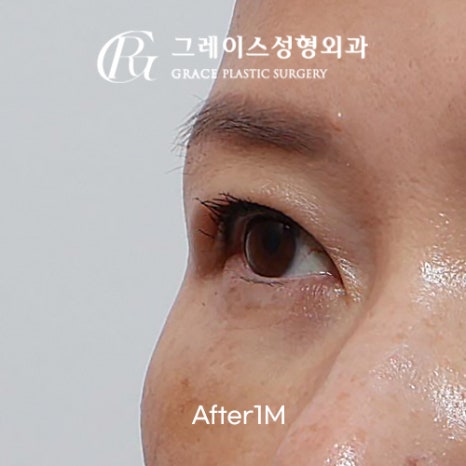 A Complete Guide to the Best Combination of Midlife Eye Surgery, from Under-Eye Fat Repositioning Costs to an I-Hole Filler Alternative image 6