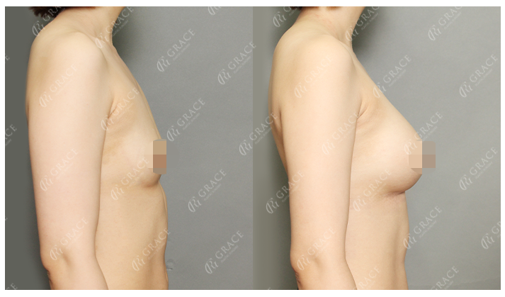 How Should You Choose a Good Breast Augmentation Clinic? image 3