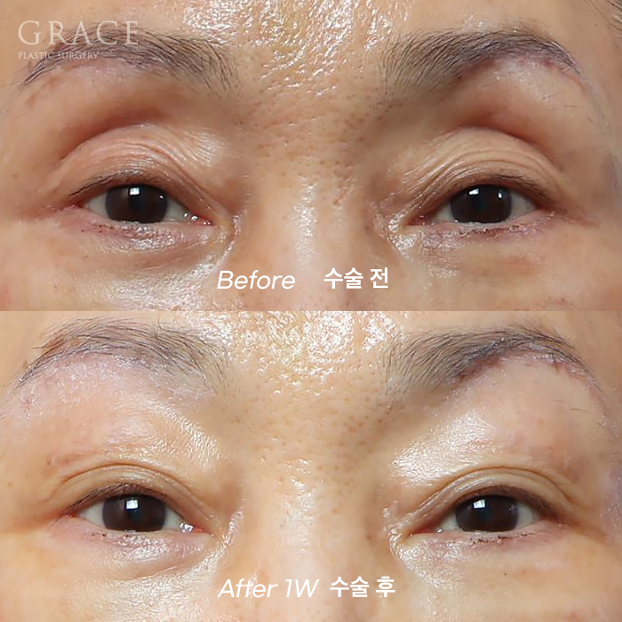 Upper Eye Hollowing and Sunken Brow Bone: Before and After 1 Week of Fat Grafting for a Patient in Her Mid-70s image 5