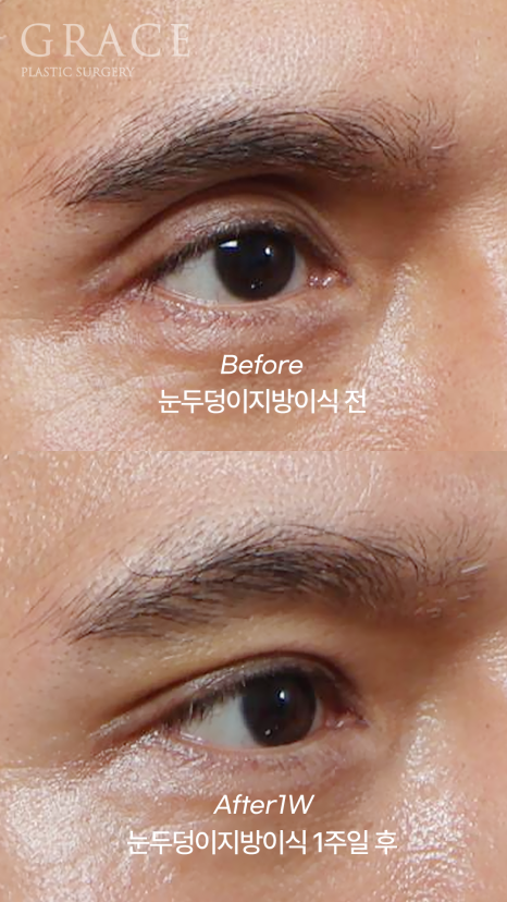 Male Brow Filler? Improvement with Eye-Hole Fat Grafting (Without Worrying About Side Effects, Scars, or Swelling) image 5