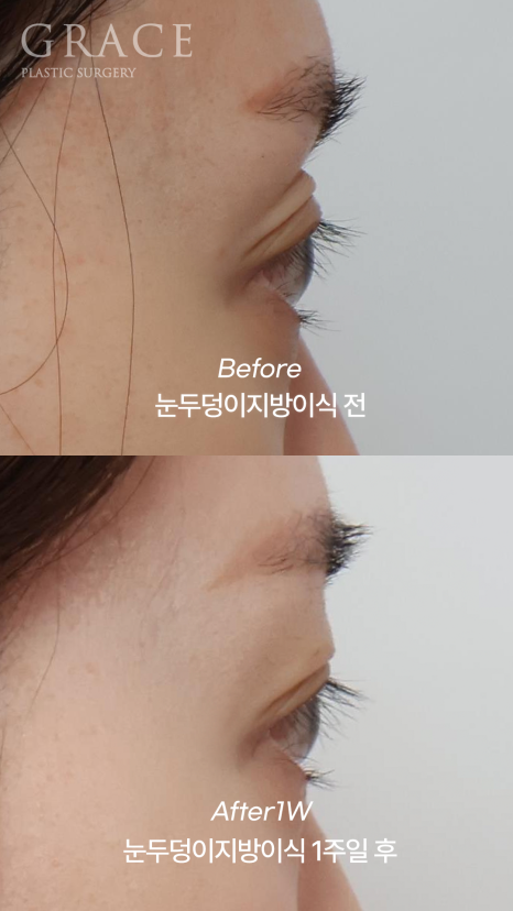 눈꺼풀 지방이식 잘하는 병원 그레이스성형외과 관련 이미지 6