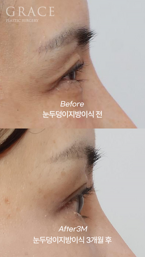 Grace Plastic Surgery 40s Case: Improved Eye-Opening Strength After Upper Eyelid Fat Grafting image 8