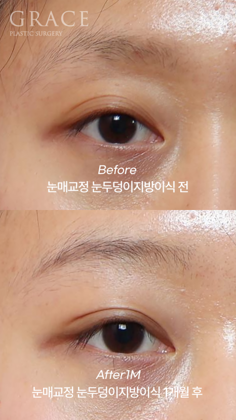 꺼진 눈두덩이 필러 대신 지방이식? 붓기&middot;부작용 없는 방법 정리 관련 이미지 3