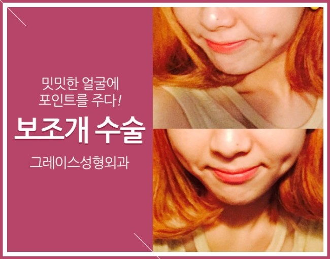 보조개수술후기, 그레이스성형외과에서 알아보자! 관련 이미지 2