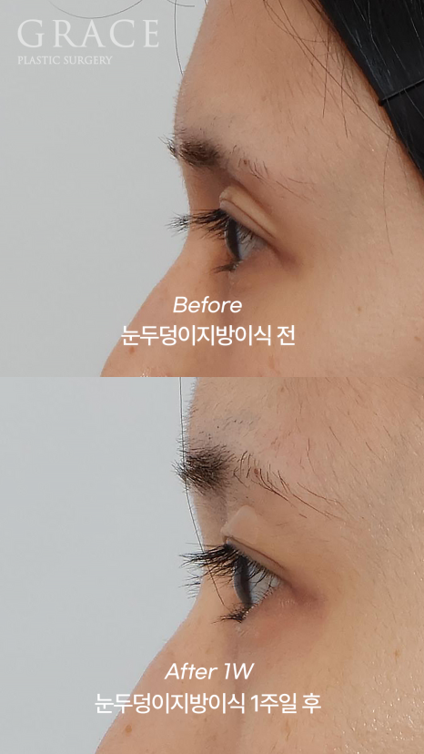 눈꺼풀 지방이식 눈 감았을 때 울퉁불퉁하지 않는 이유 전후사례로 보여드립니다 관련 이미지 6