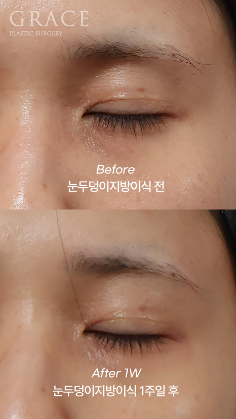 눈꺼풀 지방이식 눈 감았을 때 울퉁불퉁하지 않는 이유 전후사례로 보여드립니다 관련 이미지 2